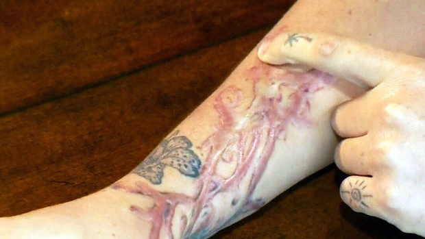 St-Eustache women claim tattoo-removal treatment resulted ...