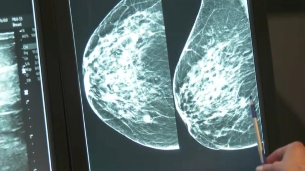 Quebec to evaluate if it will lower age of breast cancer