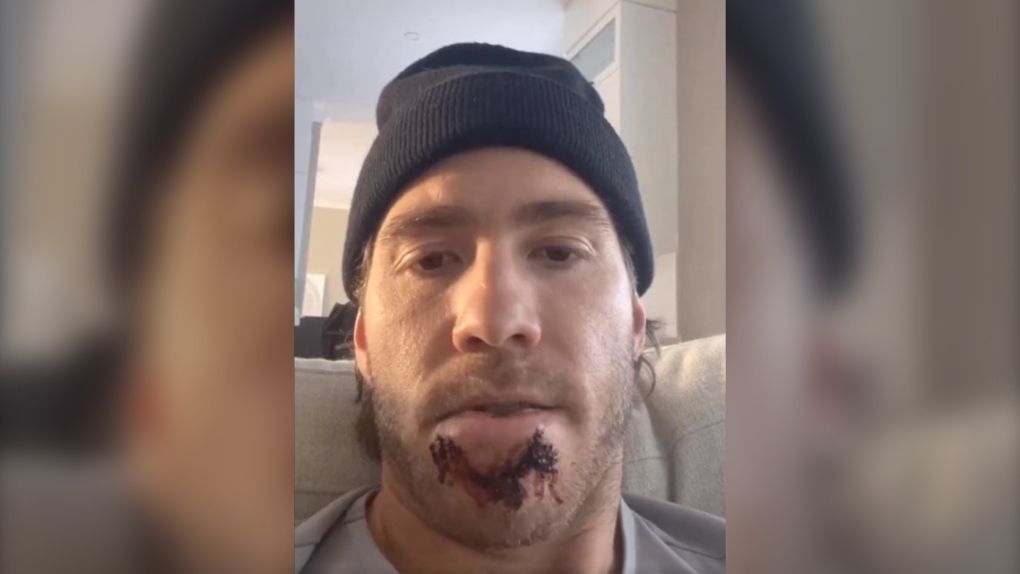 In a video posted to social media, Habs forward Mike Hoffman expressed frustration with the one-game suspension of Bruins winger A.J. Greer, who cross-checked Hoffman in the face during a game on March 23, 2023. (Mike Hoffman/TSN) 