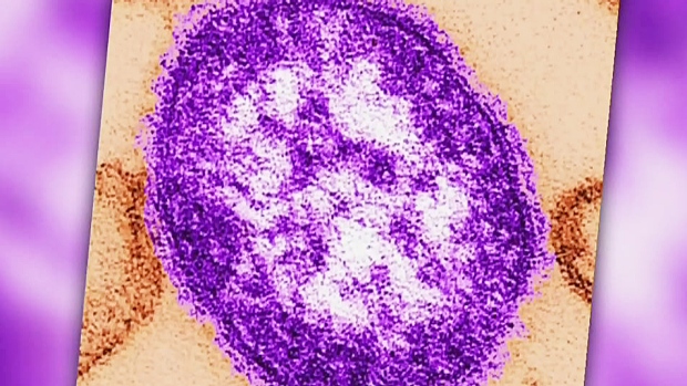 CTV Montreal: Measles hits Quebec